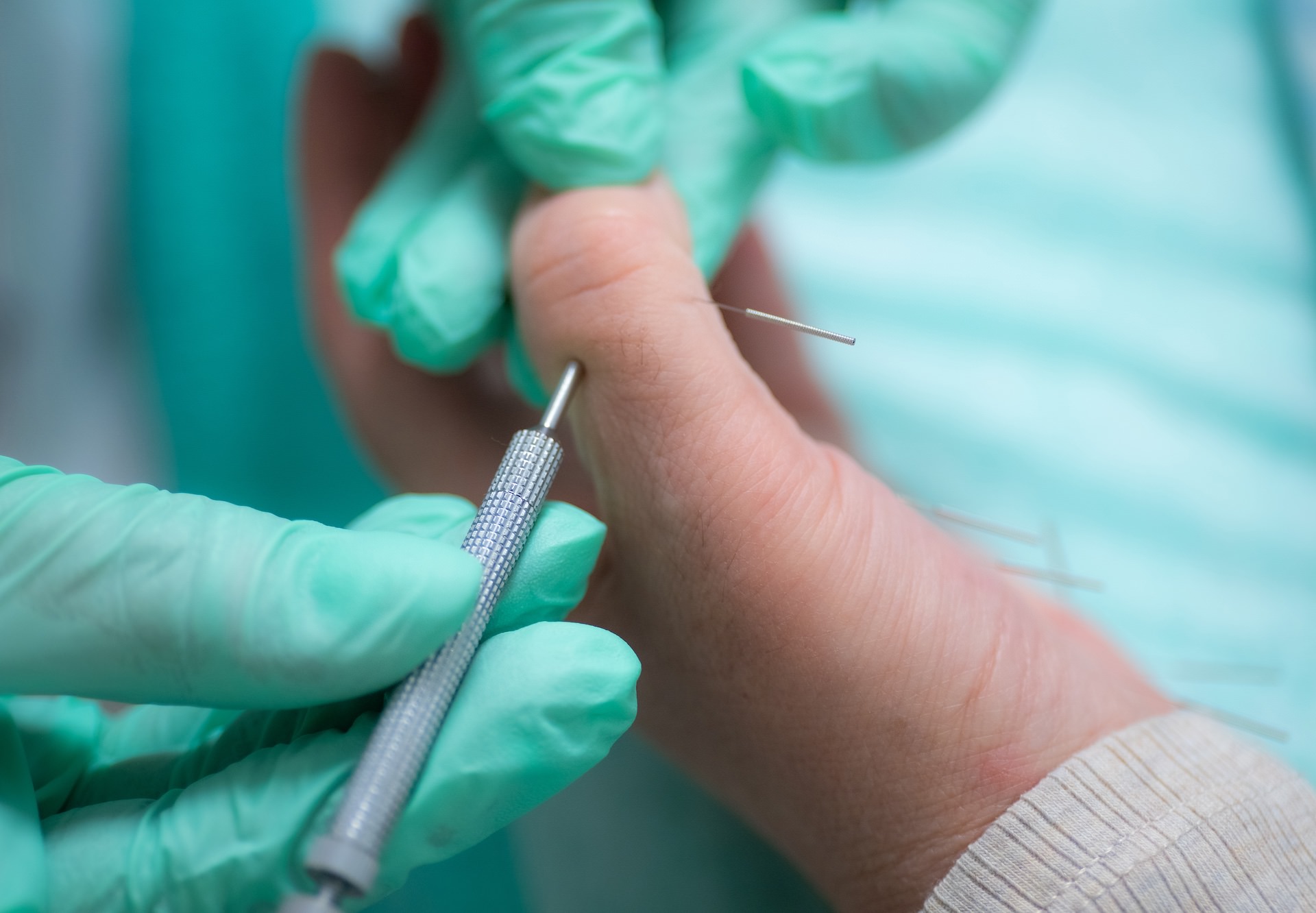 Рефлексотерапия и иглоукалывание