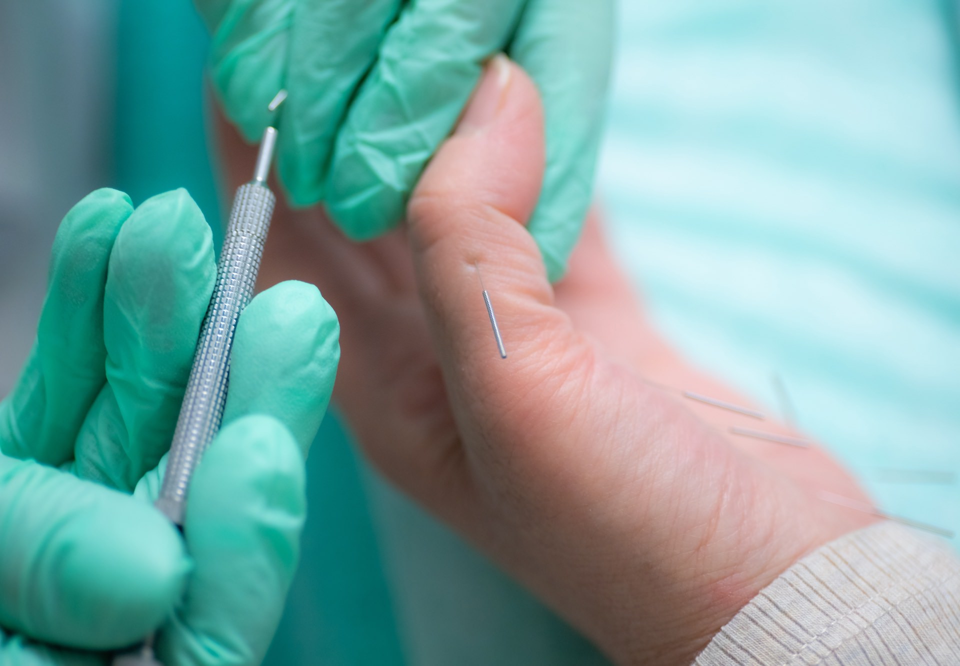 Рефлексотерапия и иглоукалывание